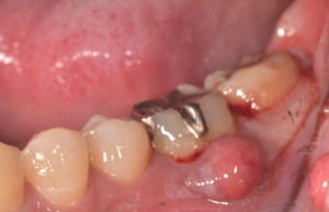 左下6歯肉腫脹