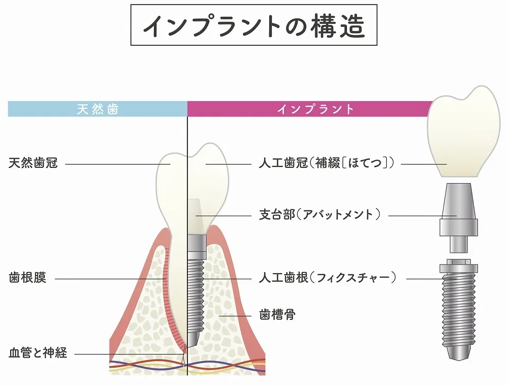 インプラントの構造